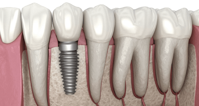 Dental implants